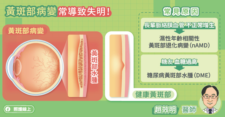 macular degeneration 2